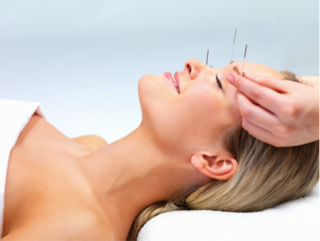 Facial Enhancement Acupuncture